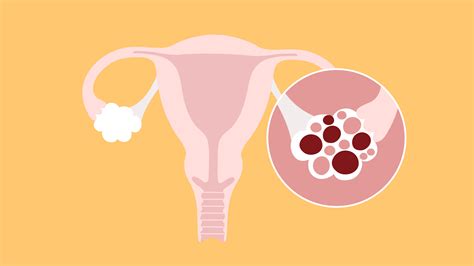 Pohľad na vaječníky a maternicu pri IVF