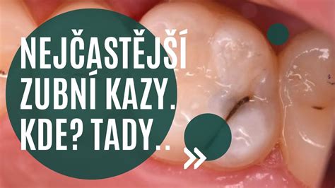 Schéma: Zdravý zub vs. zubný kaz a dôležitosť medzizubnej hygieny