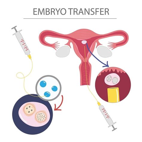 recovery after embryo transfer