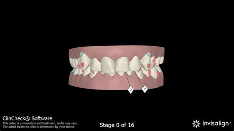 3D vizualizácia liečby Invisalign