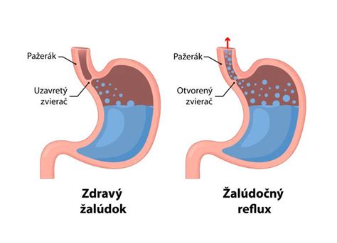 infografika zobrazujúca pažerák a žalúdok s vyznačeným refluxom