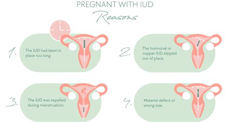 Porovnanie hormonálneho a nehormonálneho IUD