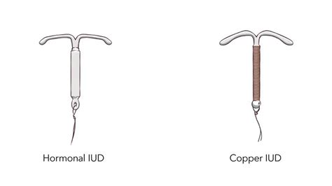 Proces zavedenia IUD