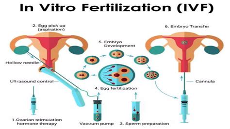 Schéma rôznych postupov asistovanej reprodukcie (IVF, IUI, GIFT, ZIFT)
