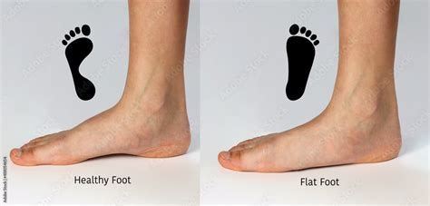 Comparison of normal foot arch and flat foot