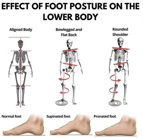 Graphic showing signs of problematic foot posture in children