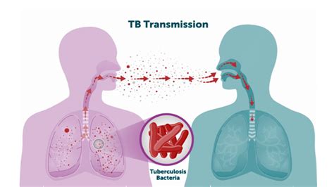 ilustrácia pľúcneho laloku napadnutého tuberkulózou s mikroskopickým pohľadom na Mycobacterium tuberculosis