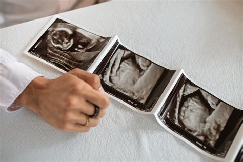 Detailné ultrazvukové meranie šijového prejasnenia (NT)