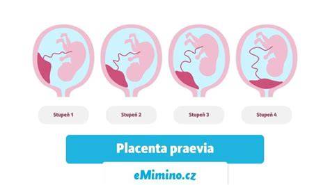Rôzne typy umiestnenia placenty v maternici