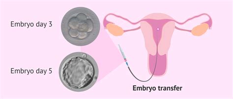 Schématické zobrazenie celého procesu IVF od stimulácie po embryotransfer