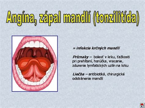 Zväčšené mandle v detskom hrdle
