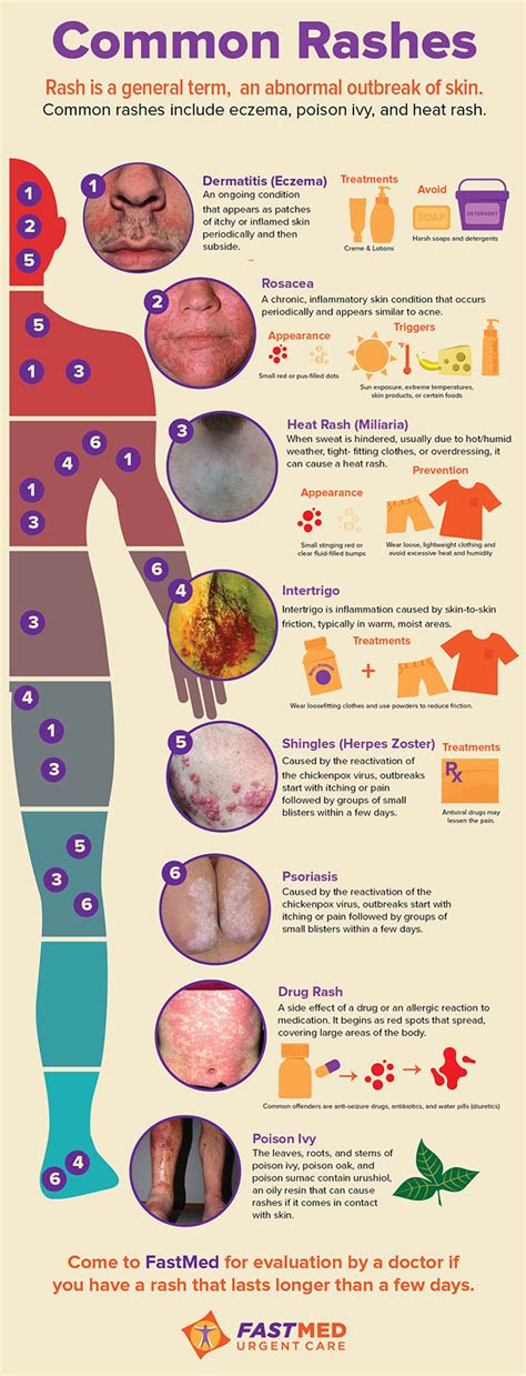 Comparison chart of childhood rashes