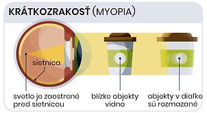 Videnie s myopiou a bez nej