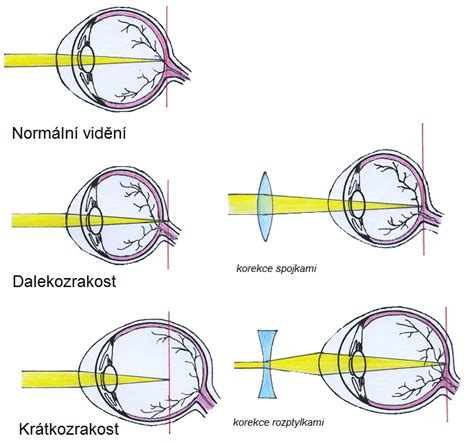 Rast oka pri krátkozrakosti