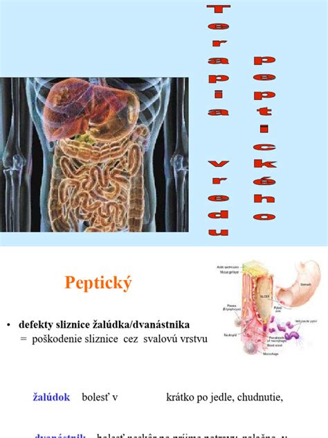 diagram znázorňujúci peptický vred v žalúdku