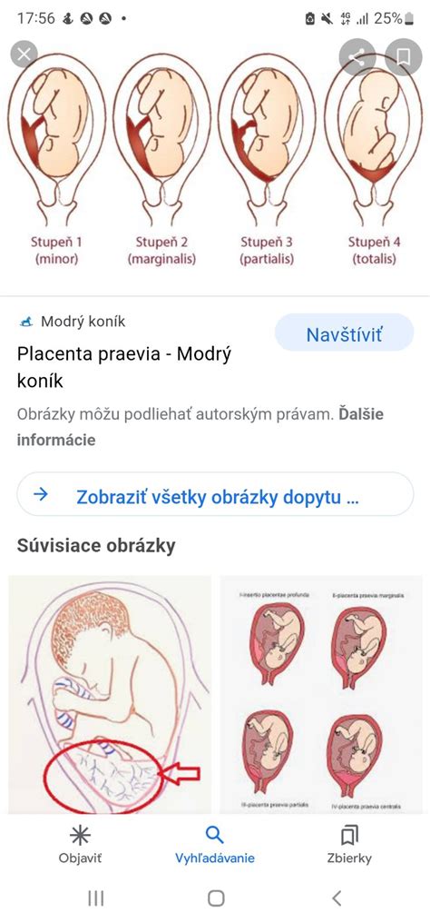Diagram pôrodných ciest a pozície bábätka
