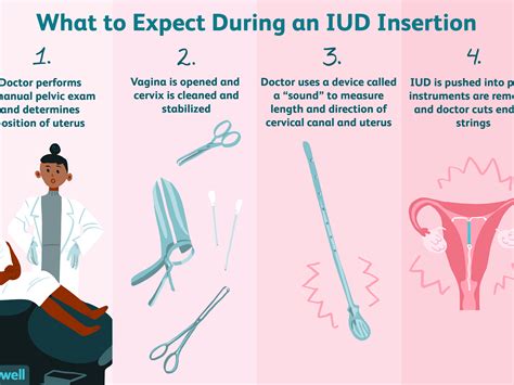 Mirena IUD placement diagram