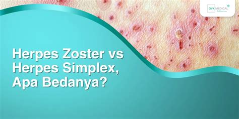 Porovnanie Herpes simplex a Herpes zoster