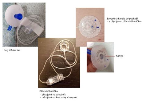 Schéma inzulínovej pumpy a infúzneho setu