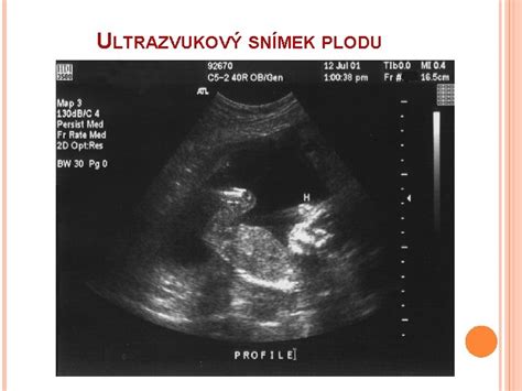 Detailný pohľad na ultrazvukový obraz plodu s označenými orgánmi
