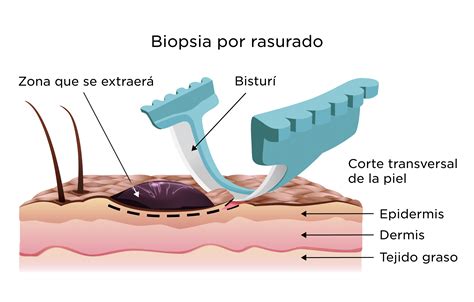 Ultrazvukom riadená biopsia